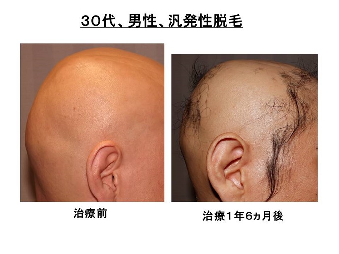 円形脱毛症　病院